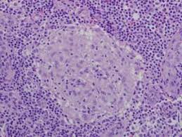 Granuloma without necrosis in a lymph node of a person with sarcoidosis.